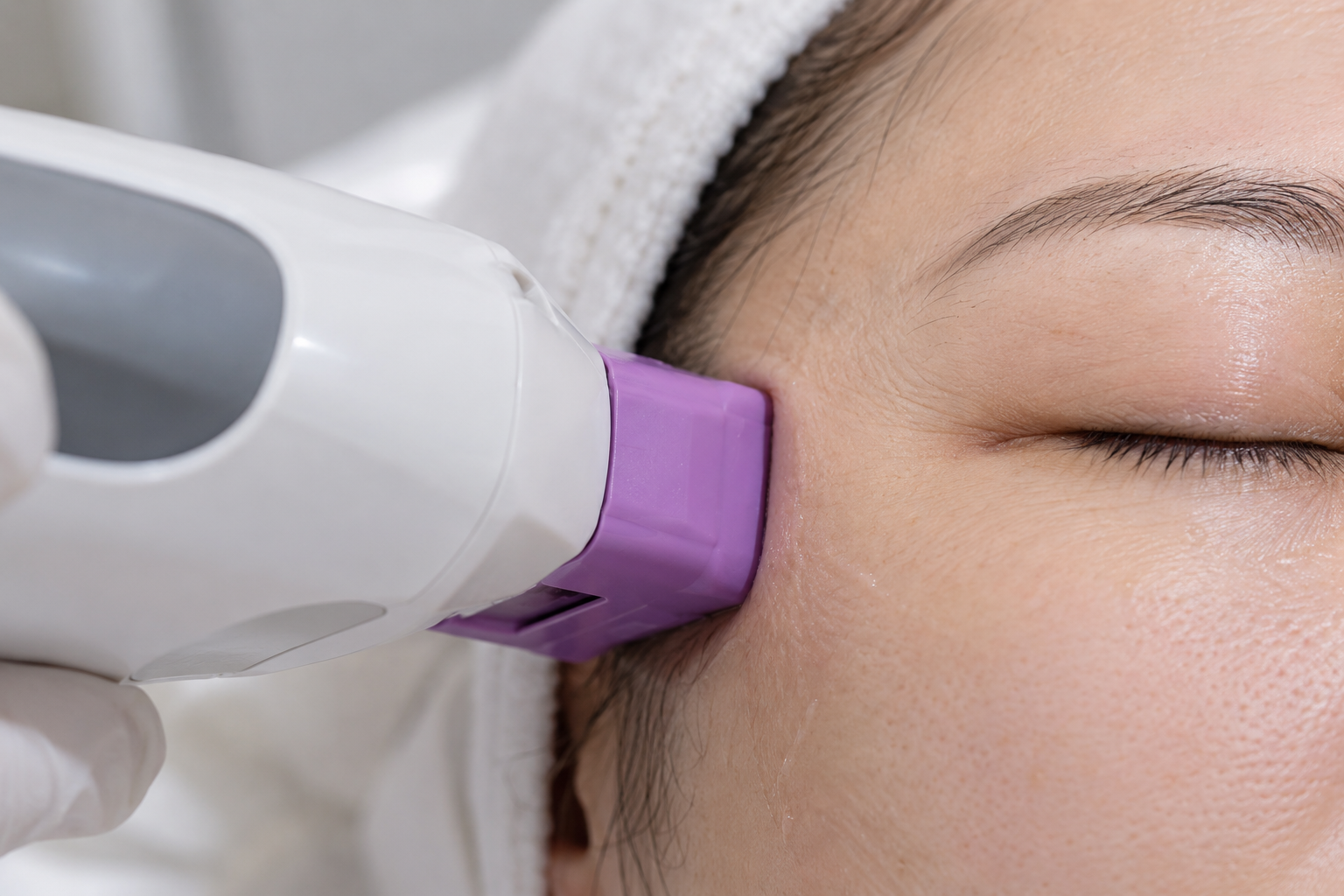 Thermage handpiece at the outer eye